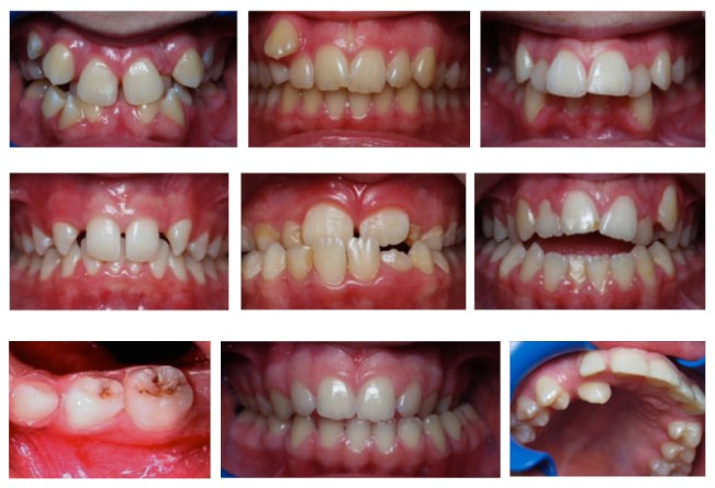 Dental Deformities