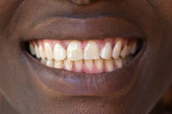 Sample teeth, well some of us are just lucky and do not need a second mortgage to fix their teeth.